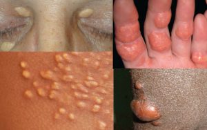 XANTHOMA contraindications In beauty therapy