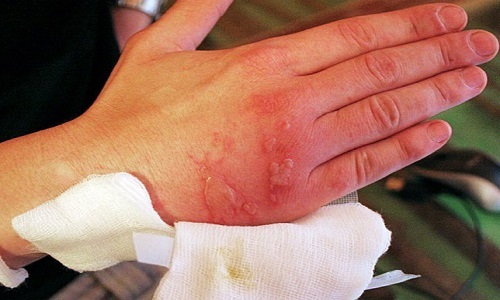 Wax burns: how to take away pain and heal. 3