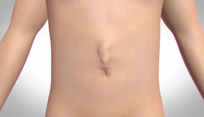 ABDOMINAL HERNIA contraindications In beauty therapy