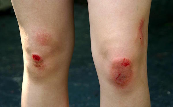 ABRASIONS contraindications In beauty therapy