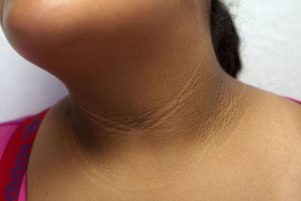 ACANTHOSIS NIGRICANS contraindications In beauty therapy