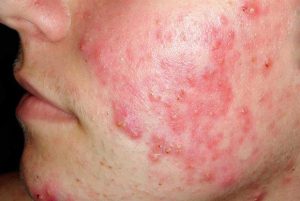 ACNE VULGARIS contraindications In beauty therapy