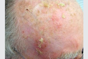 ACTINIC KERATOSIS contraindications In beauty therapy