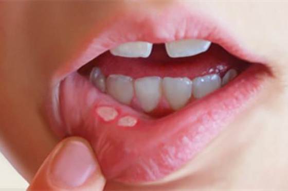 APHTHOUS STOMATITIS (MOUTH ULCERS) contraindications In beauty therapy