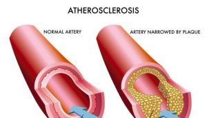 ARTERIOSCLEROSIS (ATHEROSCLEROSIS) contraindications In beauty therapy
