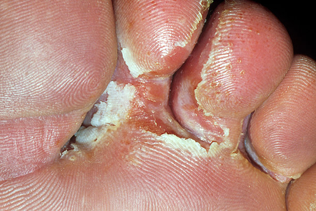 ATHLETE’S FOOT (TINEA CRURIS, TINEA PEDIS) contraindications In beauty therapy