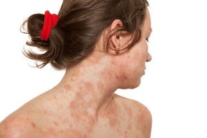 ATOPIC DERMATITIS (ATOPIC ECZEMA) contraindications In beauty therapy
