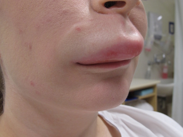 ANGIOEDEMA contraindications In beauty therapy