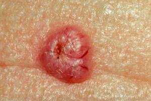 BASAL CELL CARCINOMA contraindications In beauty therapy