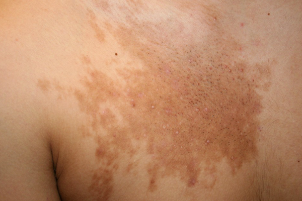 BECKER’S NEVUS contraindications In beauty therapy