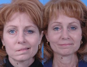 BELL’S PALSY contraindications In beauty therapy