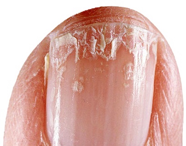 BRITTLE NAILS SYNDROME (ONYCHOSCHIZIA, ONYCHORRHEXIS) contraindications In beauty therapy