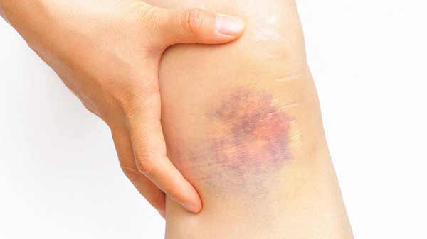 BRUISE contraindications In beauty therapy
