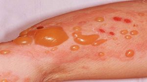 BULLOUS PEMPHIGOID contraindications In beauty therapy