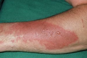 BURNS contraindications In beauty therapy