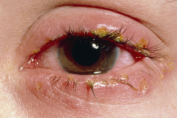 CONJUNCTIVITIS (Bacterial infections) contraindications In beauty therapy