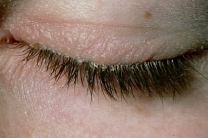 BLEPHARITIS contraindications In beauty therapy