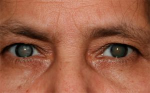 CATARACT contraindications In beauty therapy