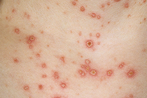 CHICKENPOX (VARICELLA) contraindications In beauty therapy