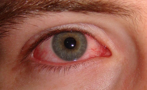 CHLAMYDIAL CONJUNCTIVITIS contraindications In beauty therapy