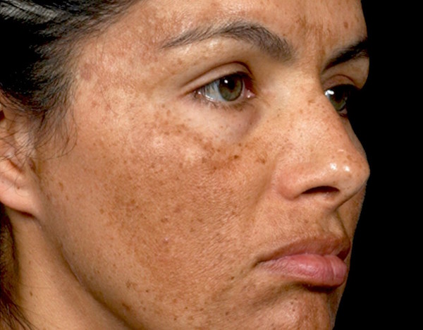 CHLOASMA (MELASMA) contraindications In beauty therapy