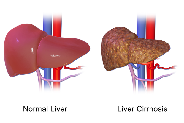 CIRRHOSIS OF THE LIVER contraindications In beauty therapy