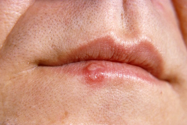 COLD SORES, HERPES (Viruses) contraindications In beauty therapy