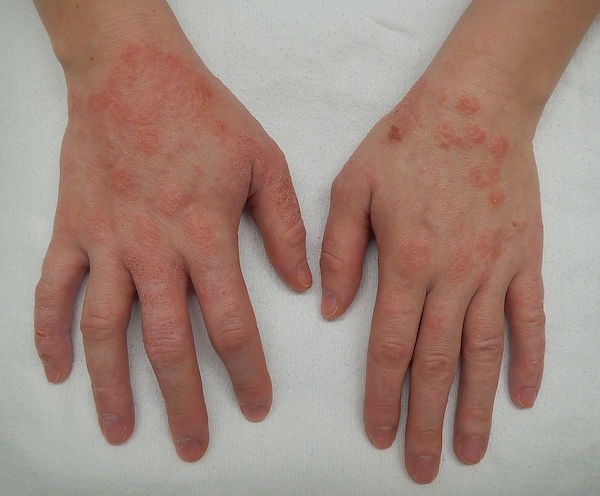 DERMATITIS contraindications In beauty therapy