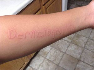 DERMATOGRAPHISM contraindications In beauty therapy