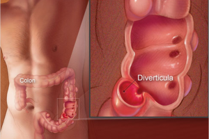 DIVERTICULITIS contraindications In beauty therapy