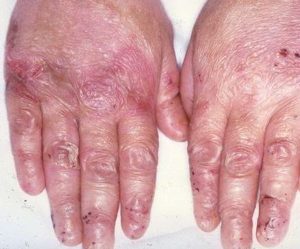 EPIDERMOLYSIS BULLOSA contraindications In beauty therapy