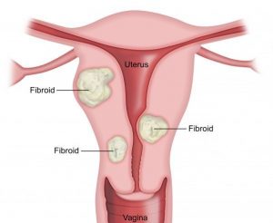 FIBROIDS contraindications In beauty therapy