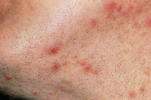 FOLLICULITIS contraindications In beauty therapy