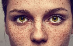 EPHELIDES (FRECKLES) contraindications In beauty therapy