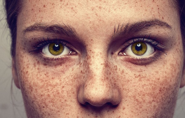 EPHELIDES (FRECKLES) contraindications In beauty therapy