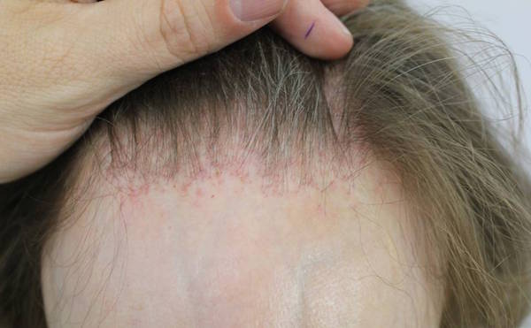 FRONTAL FIBROSING ALOPECIA contraindications In beauty therapy