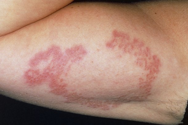 GRANULOMA ANNULARE contraindications In beauty therapy