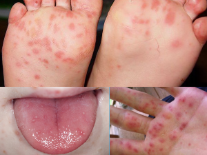 HAND-FOOT-MOUTH DISEASE contraindications In beauty therapy
