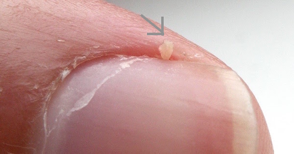 HANGNAIL contraindications In beauty therapy