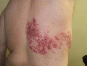 HERPES ZOSTER (SHINGLES) contraindications In beauty therapy