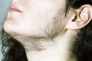 HIRSUTISM contraindications In beauty therapy