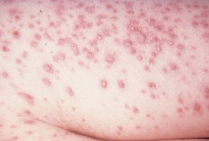 HISTOPLASMOSIS contraindications In beauty therapy