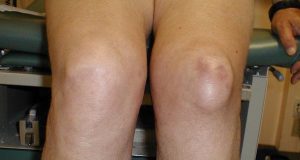 HOUSEMAID’S KNEE contraindications In beauty therapy