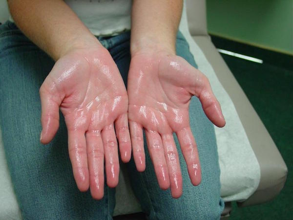 HYPERHIDROSIS contraindications In beauty therapy