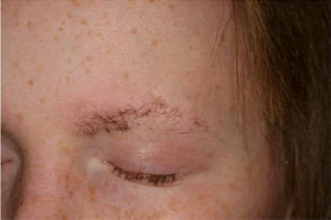 HYPOTRICHOSIS contraindications In beauty therapy