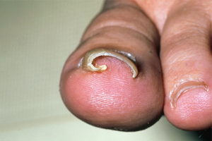 INGROWN NAIL (ONYCHOCRYPTOSIS) contraindications In beauty therapy