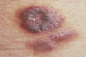 KAPOSI’S SARCOMA contraindications In beauty therapy