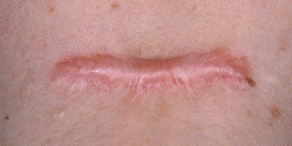 KELOID contraindications In beauty therapy