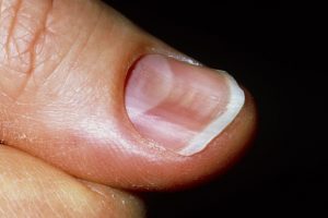 KOILONYCHIA (SPOON NAILS) contraindications In beauty therapy