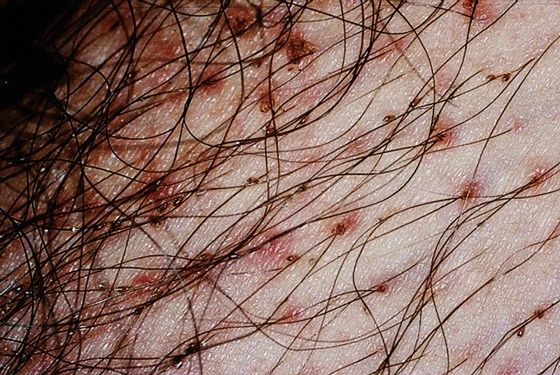 LICE(PUBIC LICE, HEAD LICE) contraindications In beauty therapy